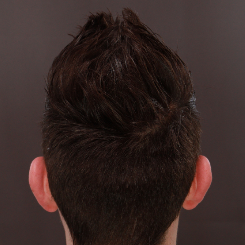 After Image: FUE Hair Transplant 1000 Grafts - back