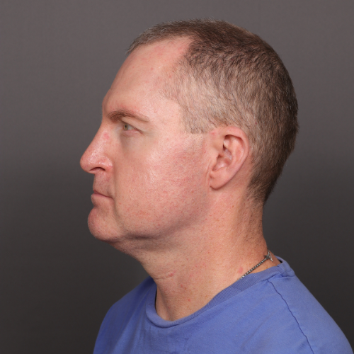 After Image: Eyebrow Transplant by Dr. Manning - left-side