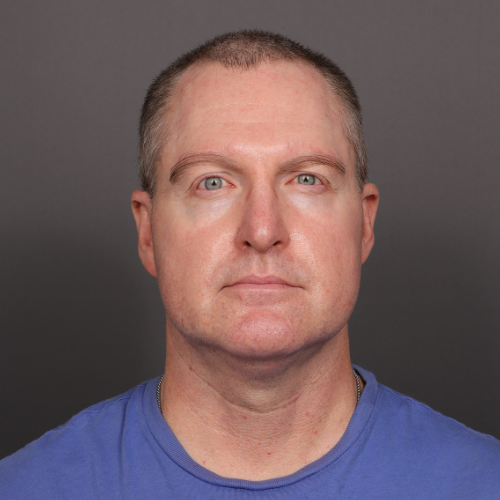 After Image: Eyebrow Transplant by Dr. Manning - front
