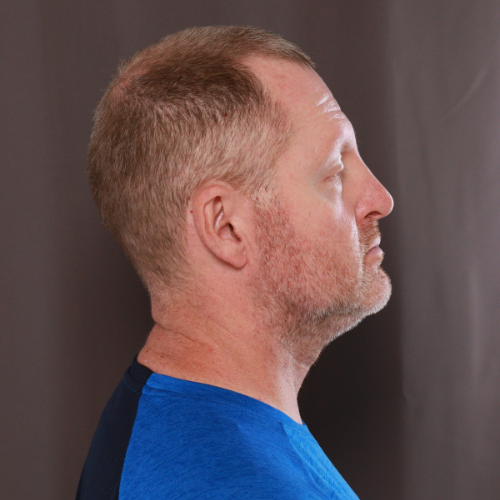 Before Image: Eyebrow Transplant by Dr. Manning - right-side
