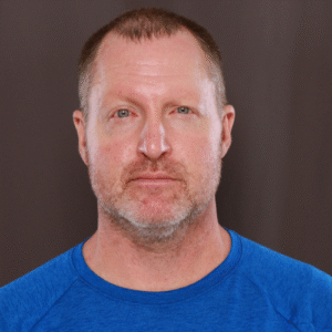 Before Image: Eyebrow Transplant by UFP Hair Restoration
