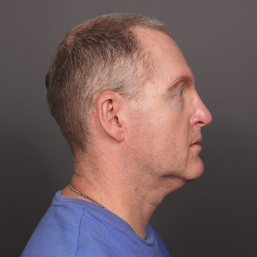 After Image: Eyebrow Transplant by Dr. Manning - right-side