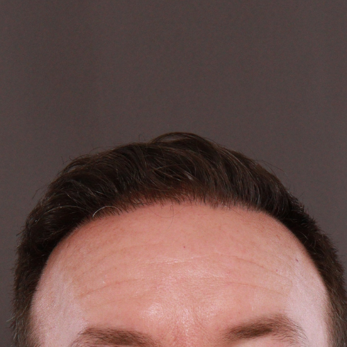 After Image: FUE & Neograft Hair Transplant - front
