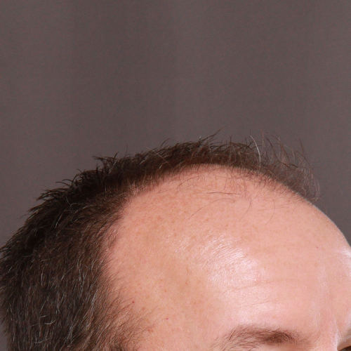 Before Image: FUE & Neograft Hair Transplant - right-front-oblique