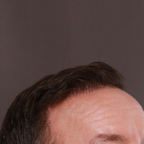 After Image: FUE & Neograft Hair Transplant - right-front-oblique
