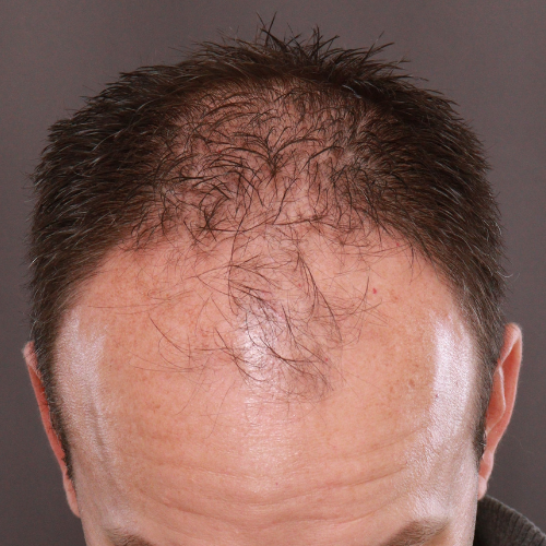 Before Image: FUE & Neograft Hair Transplant - front