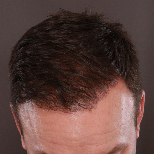 After Image: FUE & Neograft Hair Transplant - front