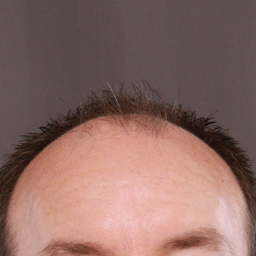 Before Image: FUE & Neograft Hair Transplant - front