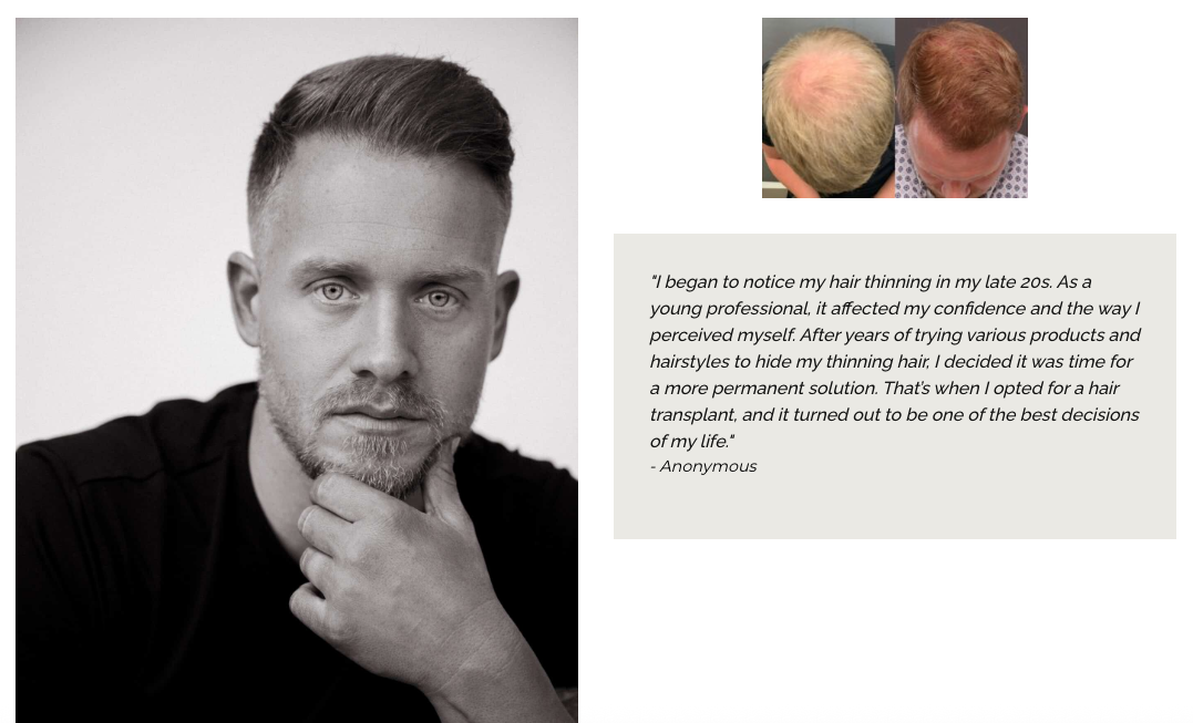 FUE Hair Transplant Surgery at UFP Hair Restoration