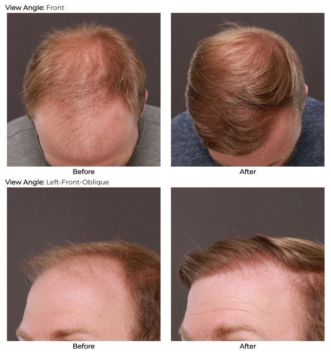 UFP Hair Restoration