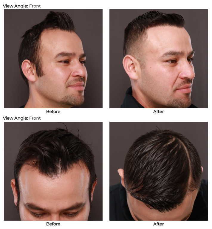 UFP Hair Restoration