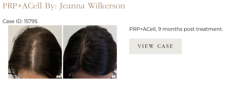 PRP at UFP Hair Restoration