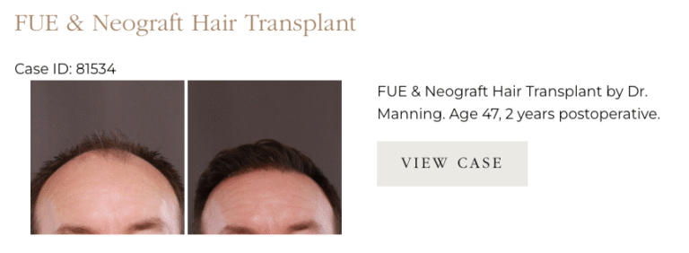 Hair Transplant at UFP Hair Restoration
