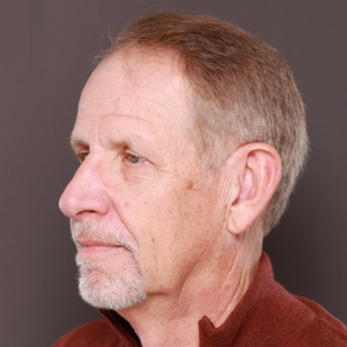 Before Image: FUE Hair & Brow Transplant, 2700 grafts - left-front-oblique