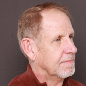 Before Image: FUE Hair & Brow Transplant, 2700 grafts