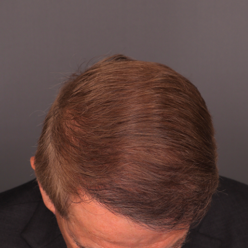 After Image: FUE Hair & Brow Transplant, 2700 grafts - front