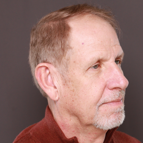 Before Image: FUE Hair & Brow Transplant, 2700 grafts - right-front-oblique
