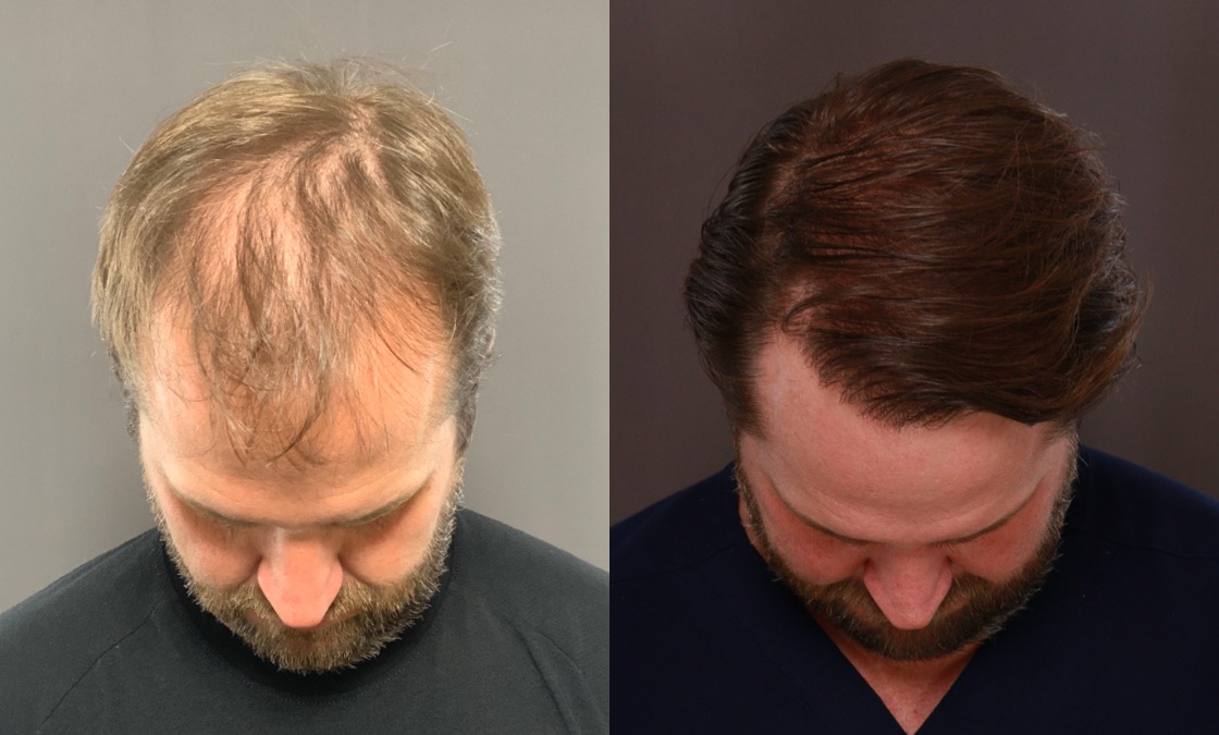 HairTransplant