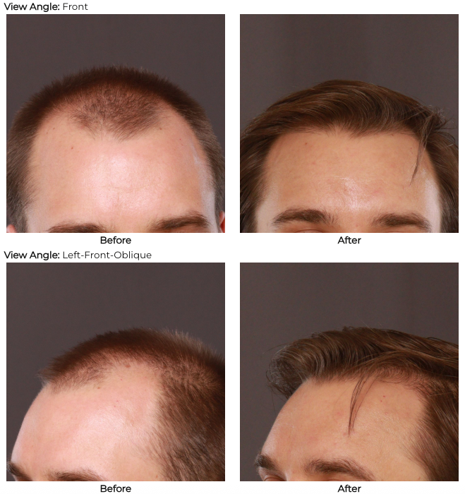 UFP Hair Restoration