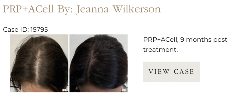 Hair Injection Therapy PRP
