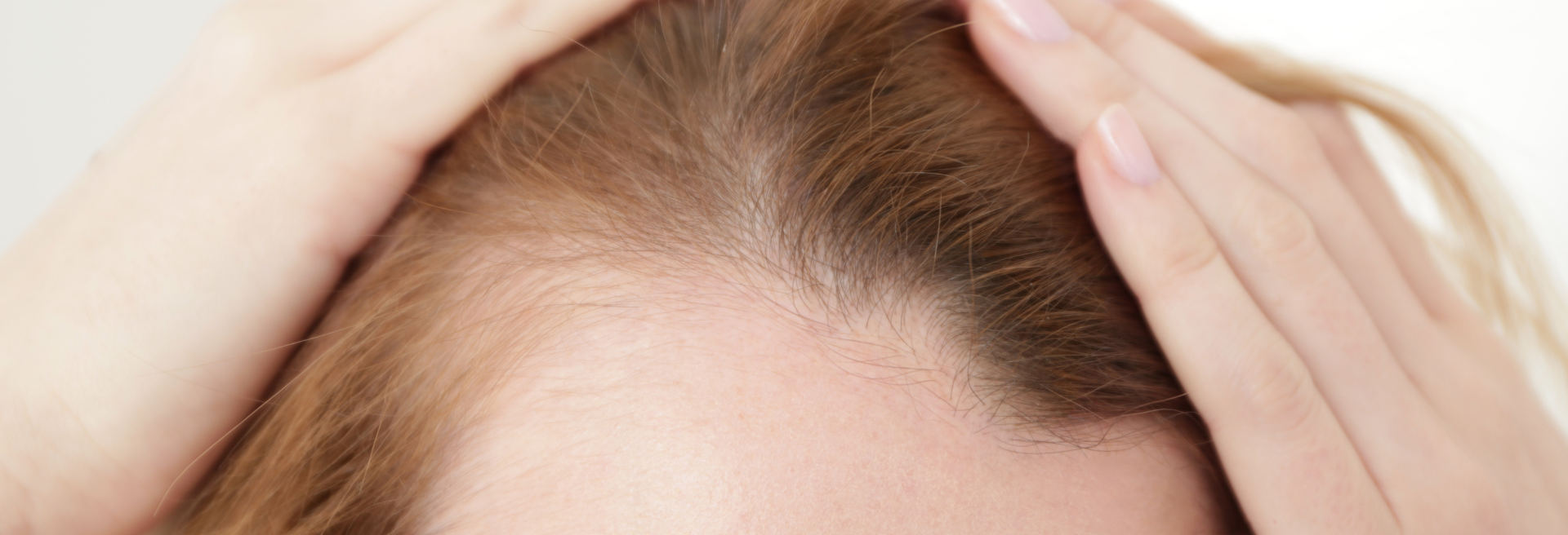 Beard Transplant UFP Hair Restoration (1)