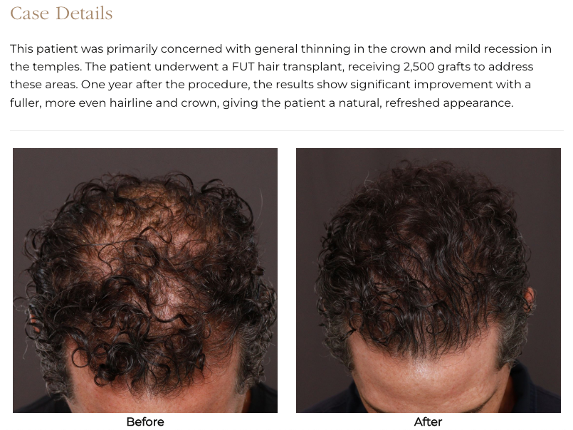 UFP Hair Restoration
