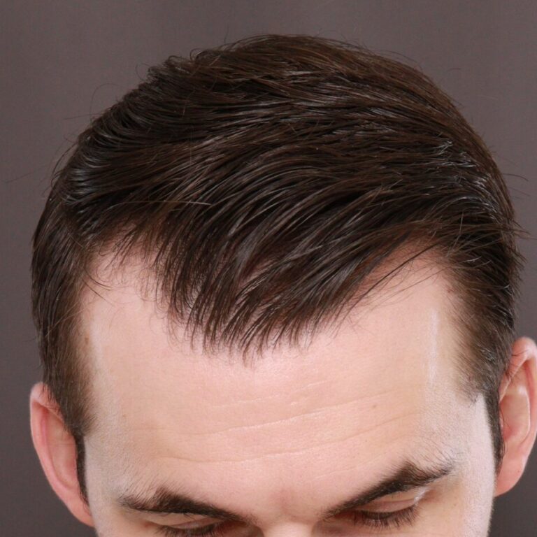 Before Image: FUE Hair Transplant, 1400 grafts - 
