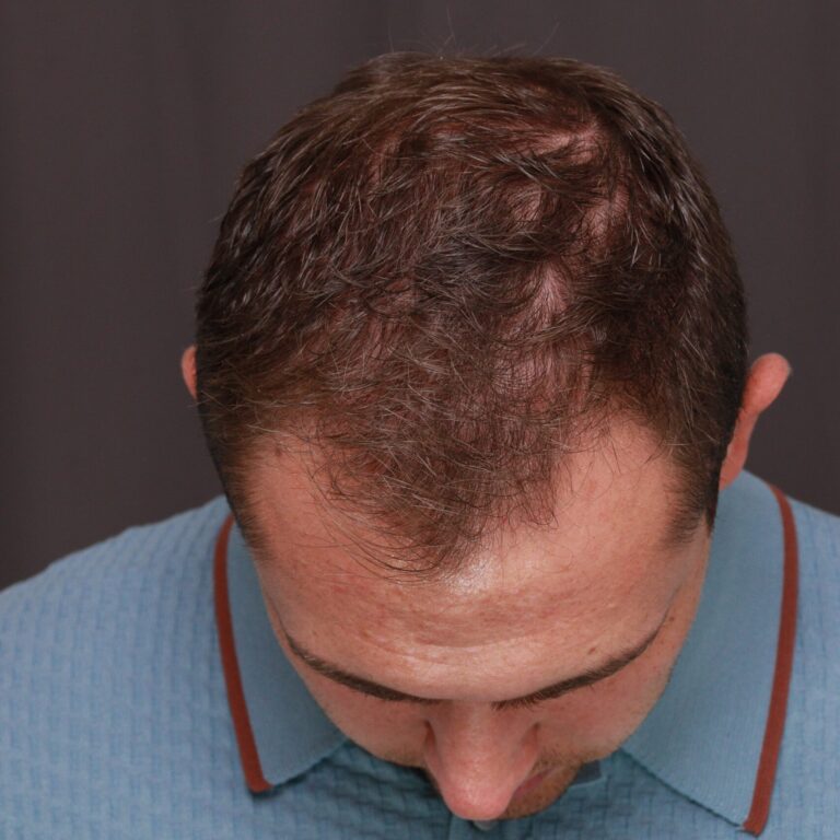 Before Image: FUT Hair Transplant, 1500 Grafts - front
