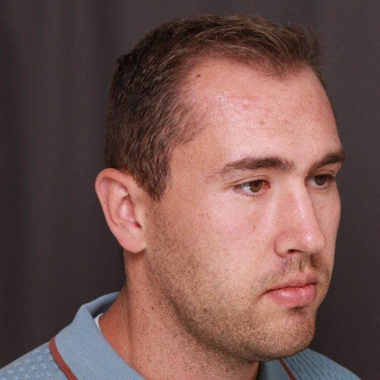 Before Image: FUT Hair Transplant, 1500 Grafts - right-front-oblique