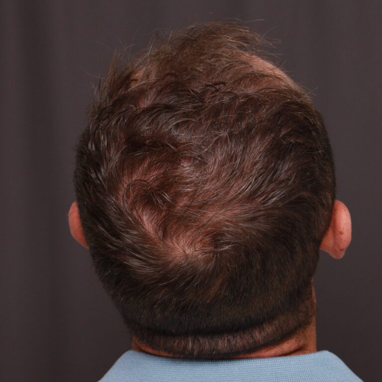 Before Image: FUT Hair Transplant, 1500 Grafts - back