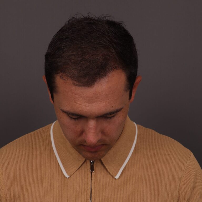 After Image: FUT Hair Transplant, 1500 Grafts - front