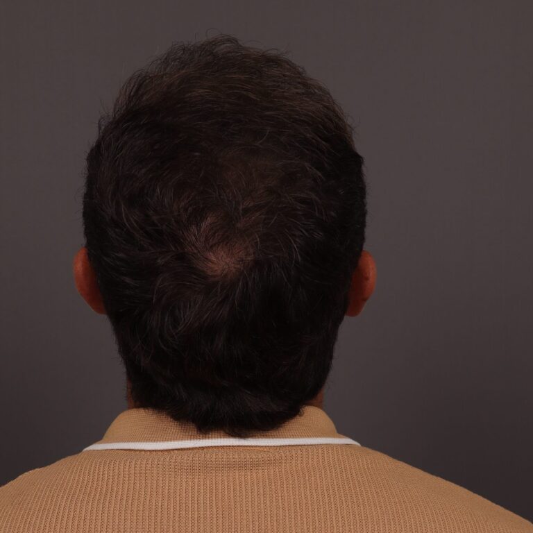 After Image: FUT Hair Transplant, 1500 Grafts - back