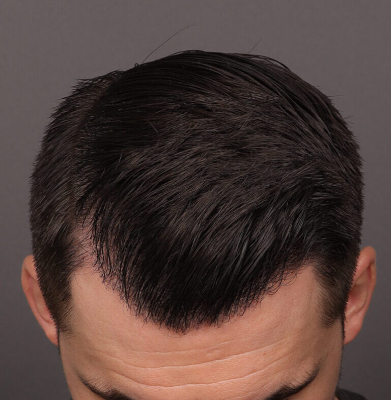 After Image: FUE Hair Transplant, 1400 grafts - 