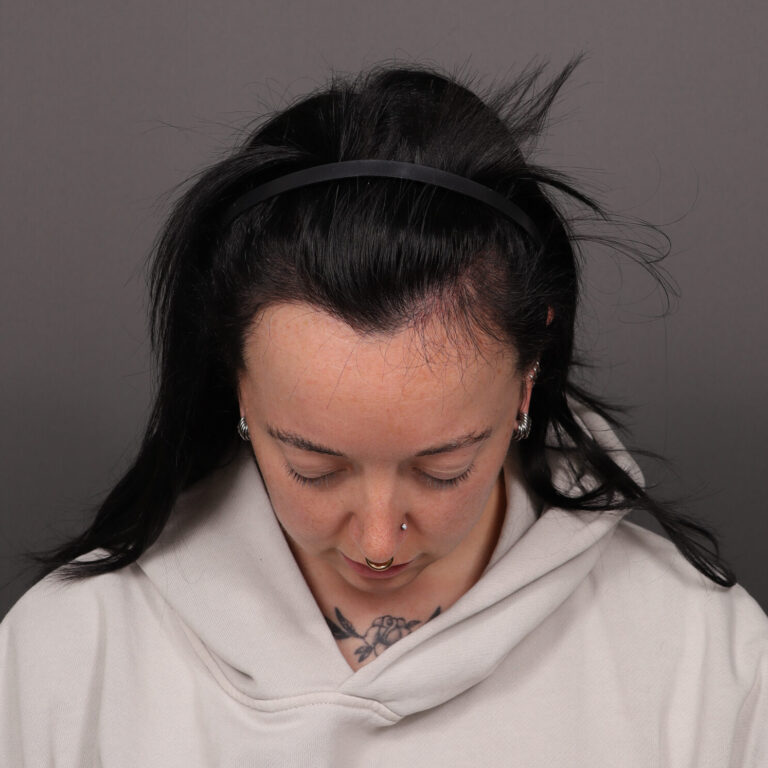 After Image: FUT Hair Transplant, 2600 grafts - front