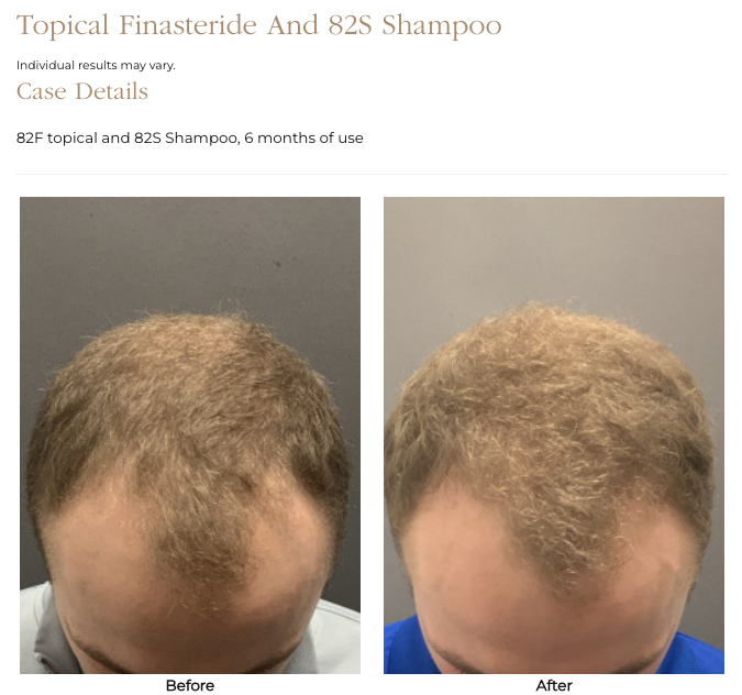 Hair transplant results enhanced through comprehensive hair health support. UFP Hair Restoration