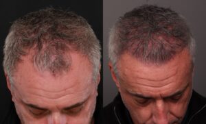 Before Image: 2 FUT hair transplants