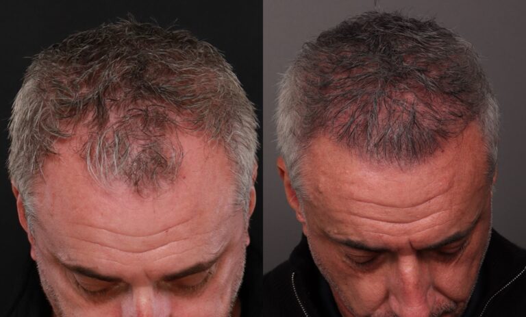 Before Image: 2 FUT hair transplants - front