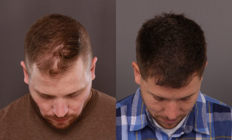 After Image: FUE, Neograft Hair Transplant - front