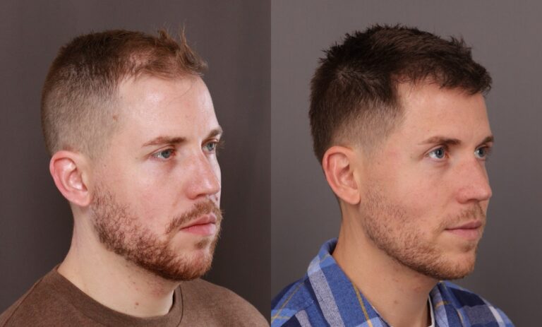 Before Image: FUE, Neograft Hair Transplant - front