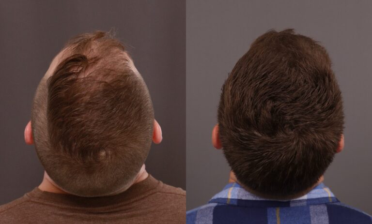 After Image: FUE, Neograft Hair Transplant - front