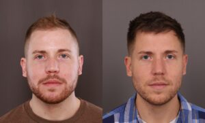 Before Image: FUE, FUE hair transplant