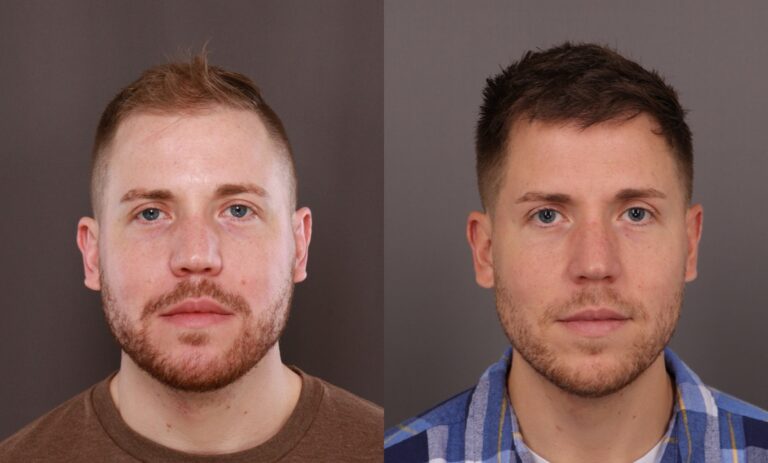 Before Image: FUE, Neograft Hair Transplant - front