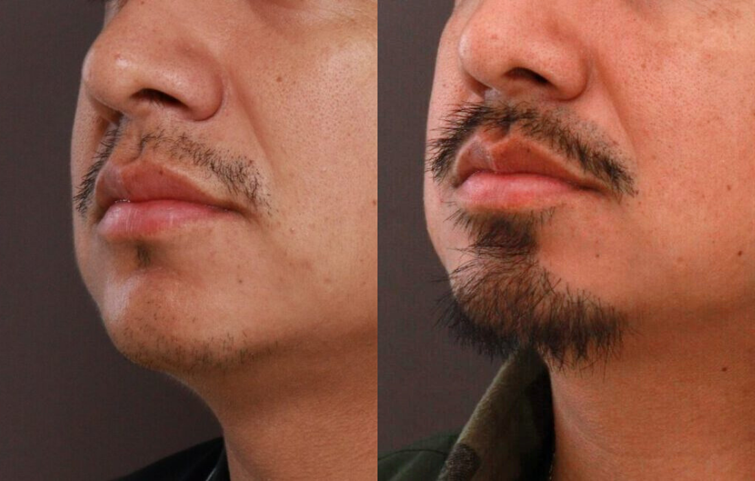 Beard Transplant UFP Hair Restoration