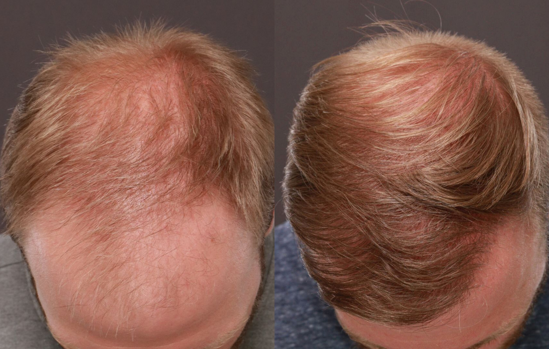 FUE Hair Transplant