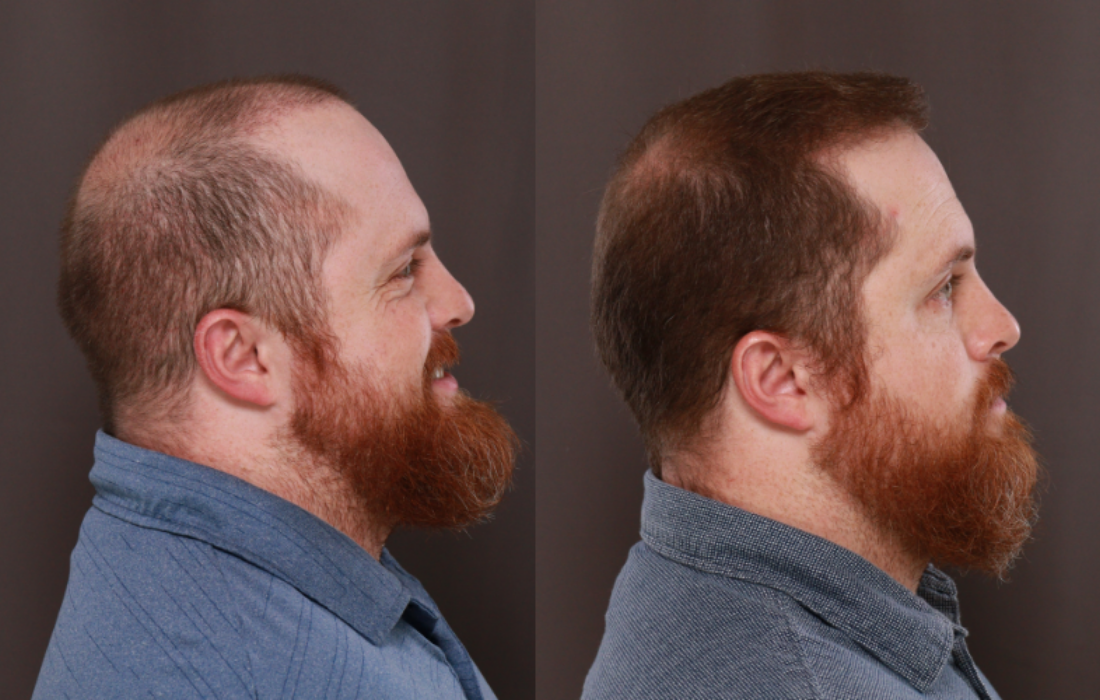 Hair Injection Therapy UFP Hair Restoration Before and After