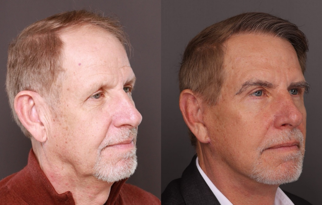 UFP Hair Restoration Before and After Hair Transplant
