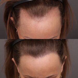 Before Image: 2000 Graft FUT Hair Transplant