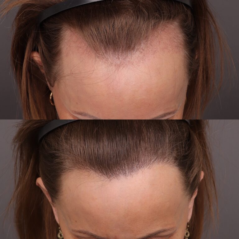 Before Image: 2000 Graft FUT Hair Transplant - front