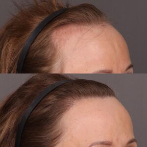 After Image: 2000 Graft FUT Hair Transplant