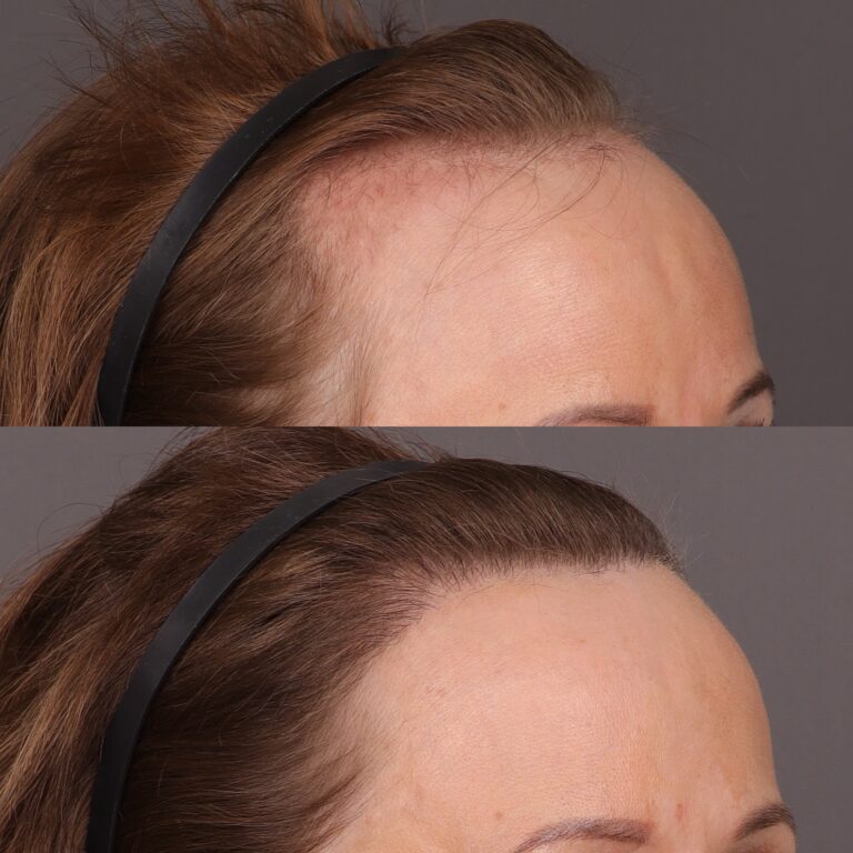 After Image: 2000 Graft FUT Hair Transplant - front